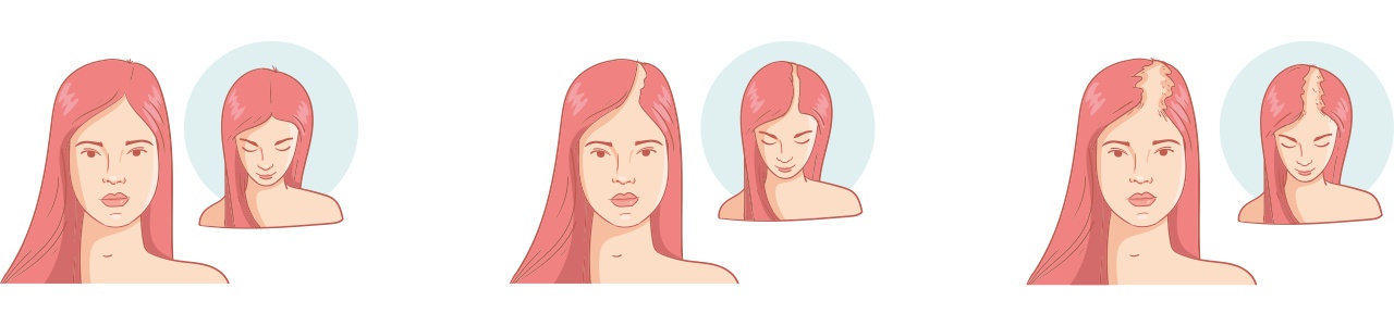 Greffe de cheveux pour femmes İstanbul